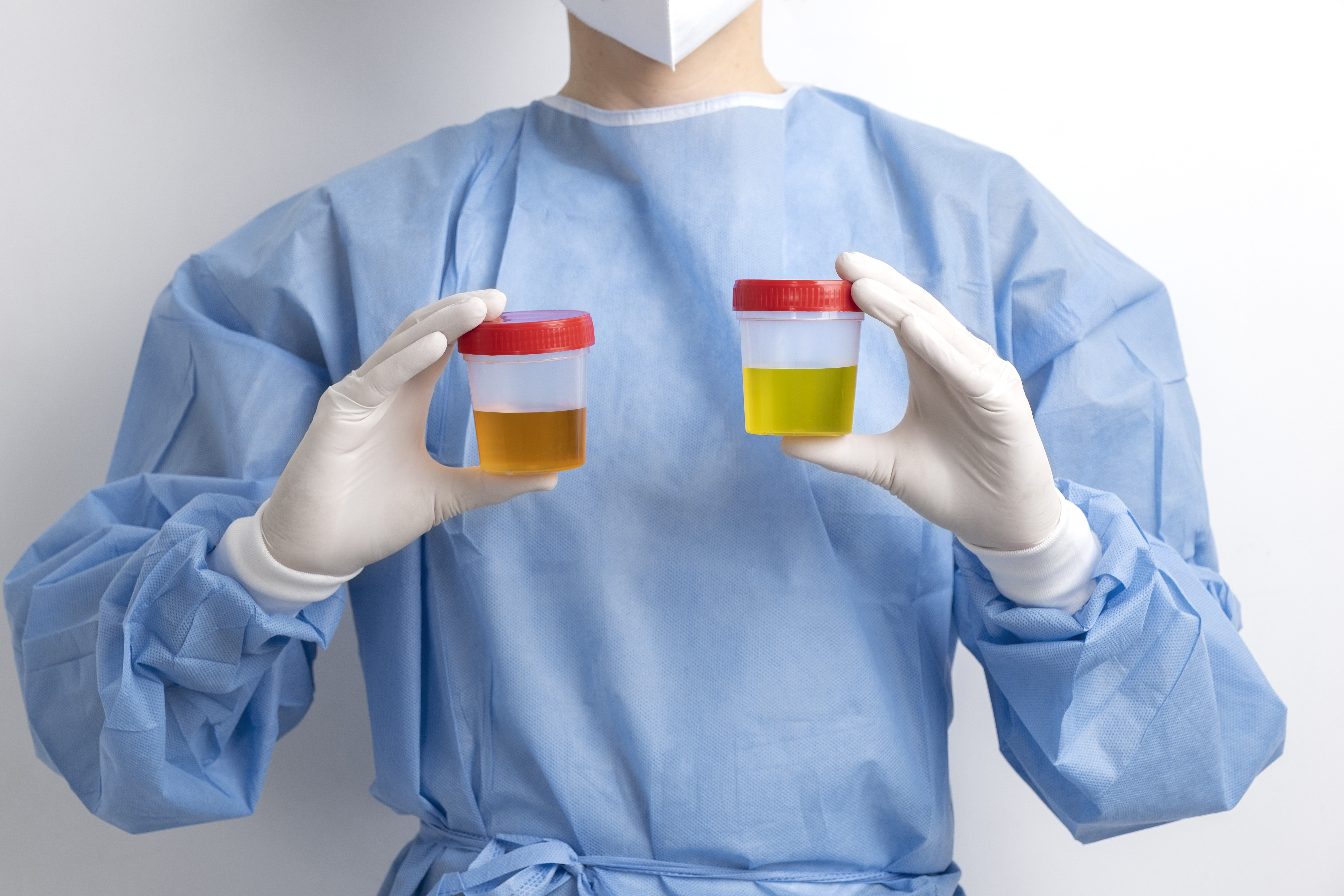 Asam Urat Urine